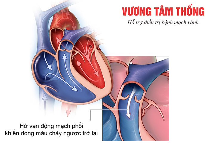 Hình ảnh tim bị hở van động mạch chủ.jpg